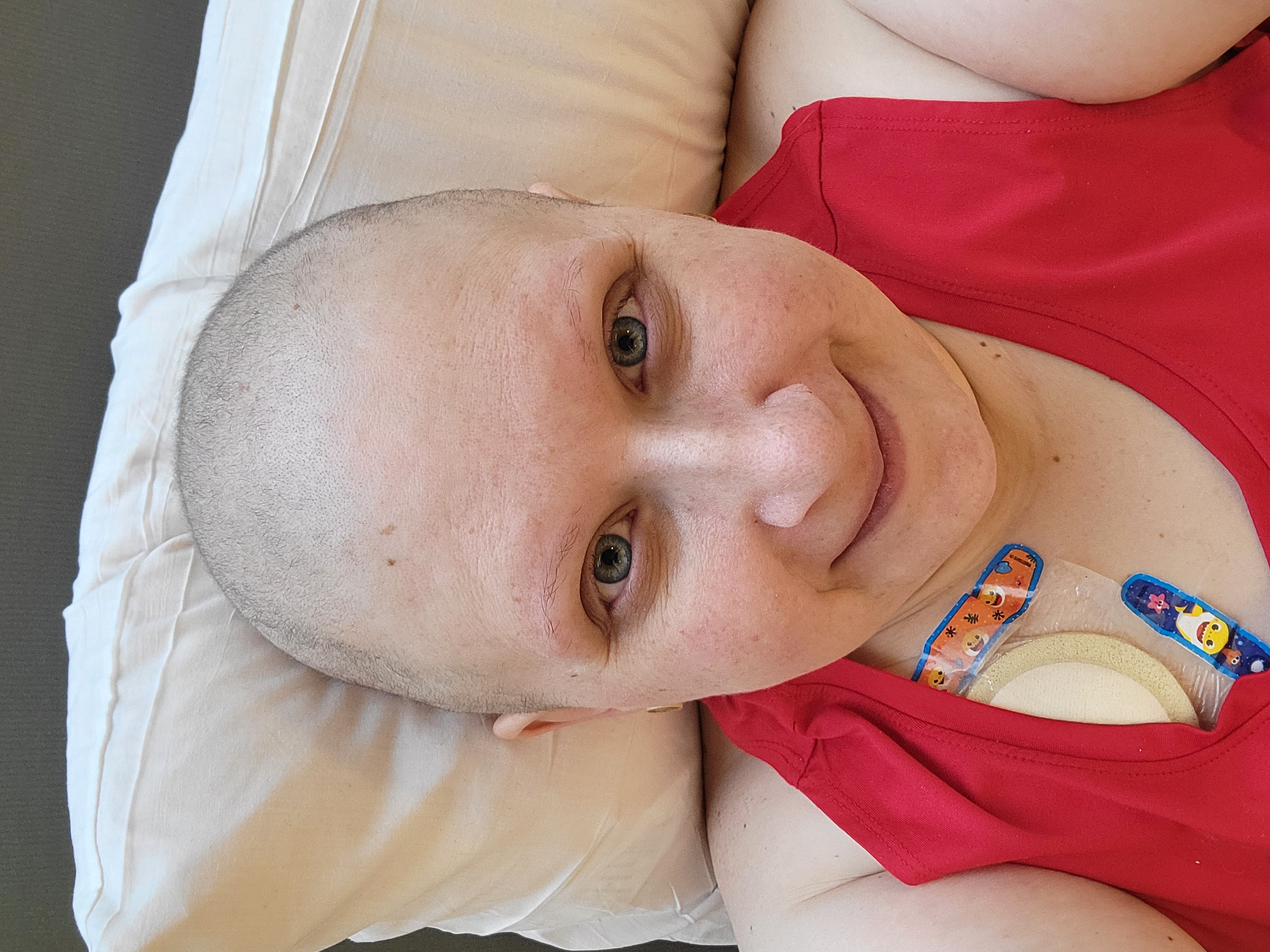 A bald woman with no eyebrows in a red tank top with bandages showing near her shoulder.