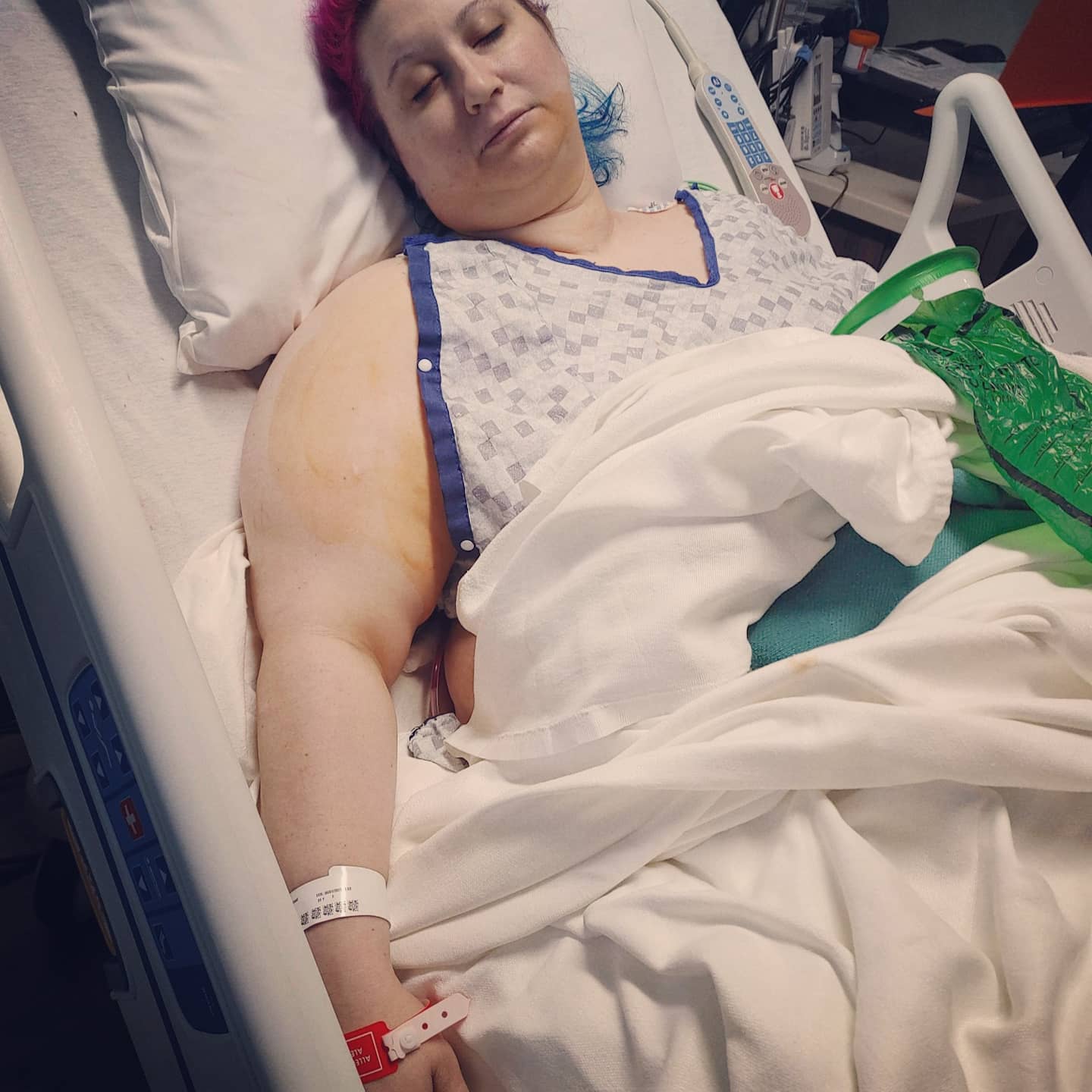 A girl asleep in a hospital bed, after having a double mastectomy surgery.