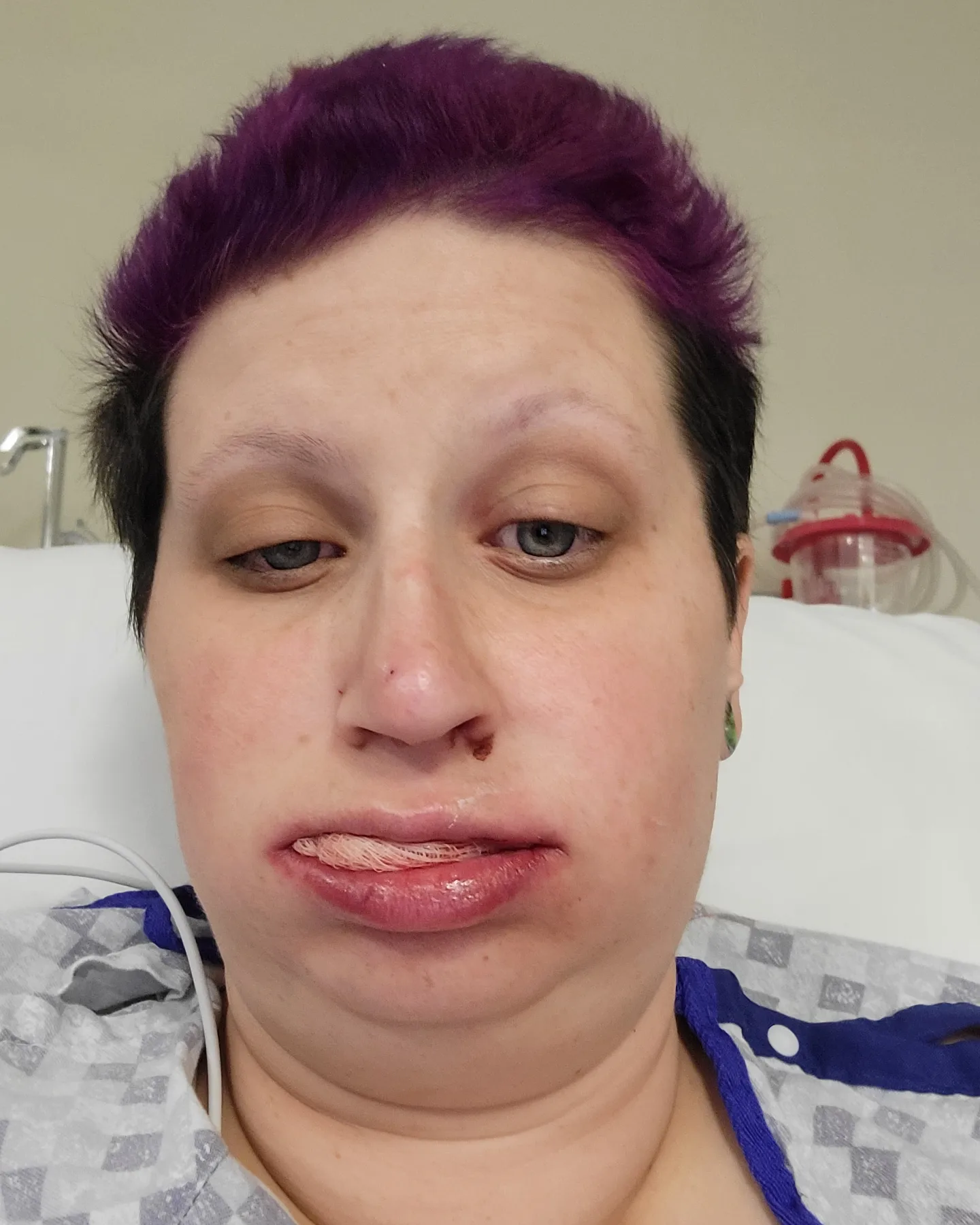 A close up of a woman in a hospital bed with bloodied guaze in her mouth after having teeth extracted.
